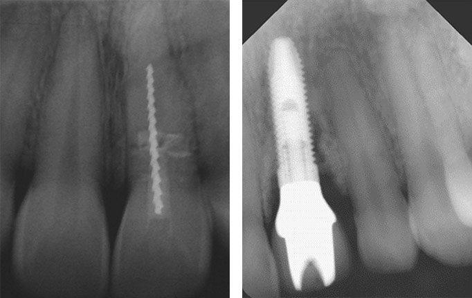 Frontzahntrauma